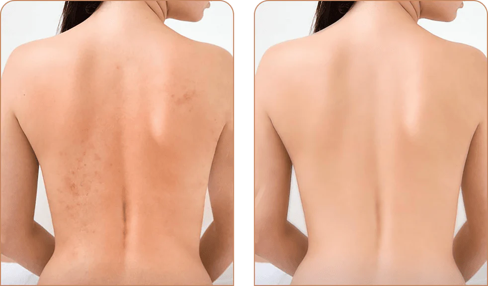 SKINCLEAN: 1+1 GRATIS TOALLA DE BAÑO EXFOLIANTE💦