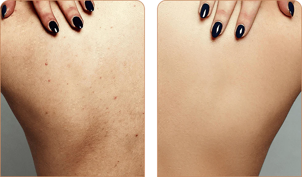 SKINCLEAN: 1+1 GRATIS TOALLA DE BAÑO EXFOLIANTE💦