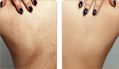 SKINCLEAN: 1+1 GRATIS TOALLA DE BAÑO EXFOLIANTE💦