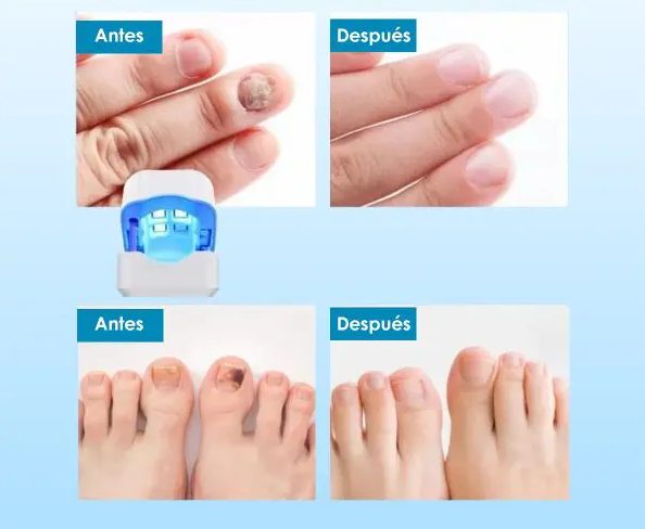 FINGERGUARD: PROTECTOR DEDOS 🛡️👌