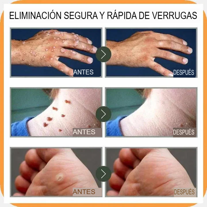 WART CREAM: PROMO 2X1 CREMA REMOVEDORA DE VERRUGAS CON INGREDIENTES NATURALES 🌱💎